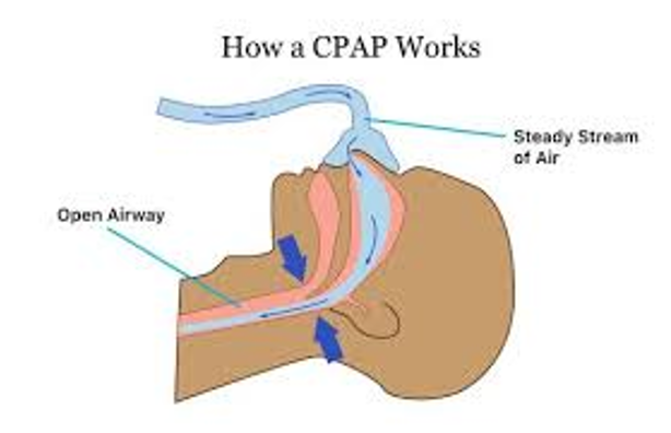 <p>What does this refer to</p><ul><li><p>Weight loss</p><ul><li><p>Weight loss medications</p></li><li><p>Exercise</p></li><li><p>Severely obese &amp; failure of conservative treatment</p><ul><li><p>Weight loss surgery</p></li></ul></li></ul></li><li><p>Surgical intervention (non-responders)</p><ul><li><p>Uvulopalatopharyngoplasty (UPPP)</p></li><li><p>Nasal septoplasty</p></li><li><p>Tracheostomy</p></li></ul></li><li><p>Continuous positive airway pressure (CPAP) </p></li></ul><p></p>