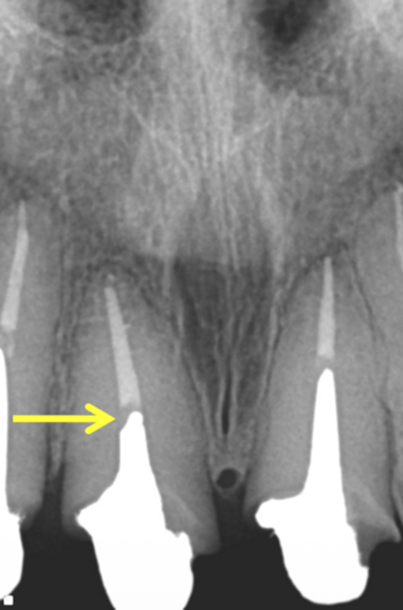 <p>Which condition(s) of post on tooth #8 should be corrected?</p><p>A. Extend post length more apically</p><p>B. Change the direction of post</p><p>C. Both of the above</p>