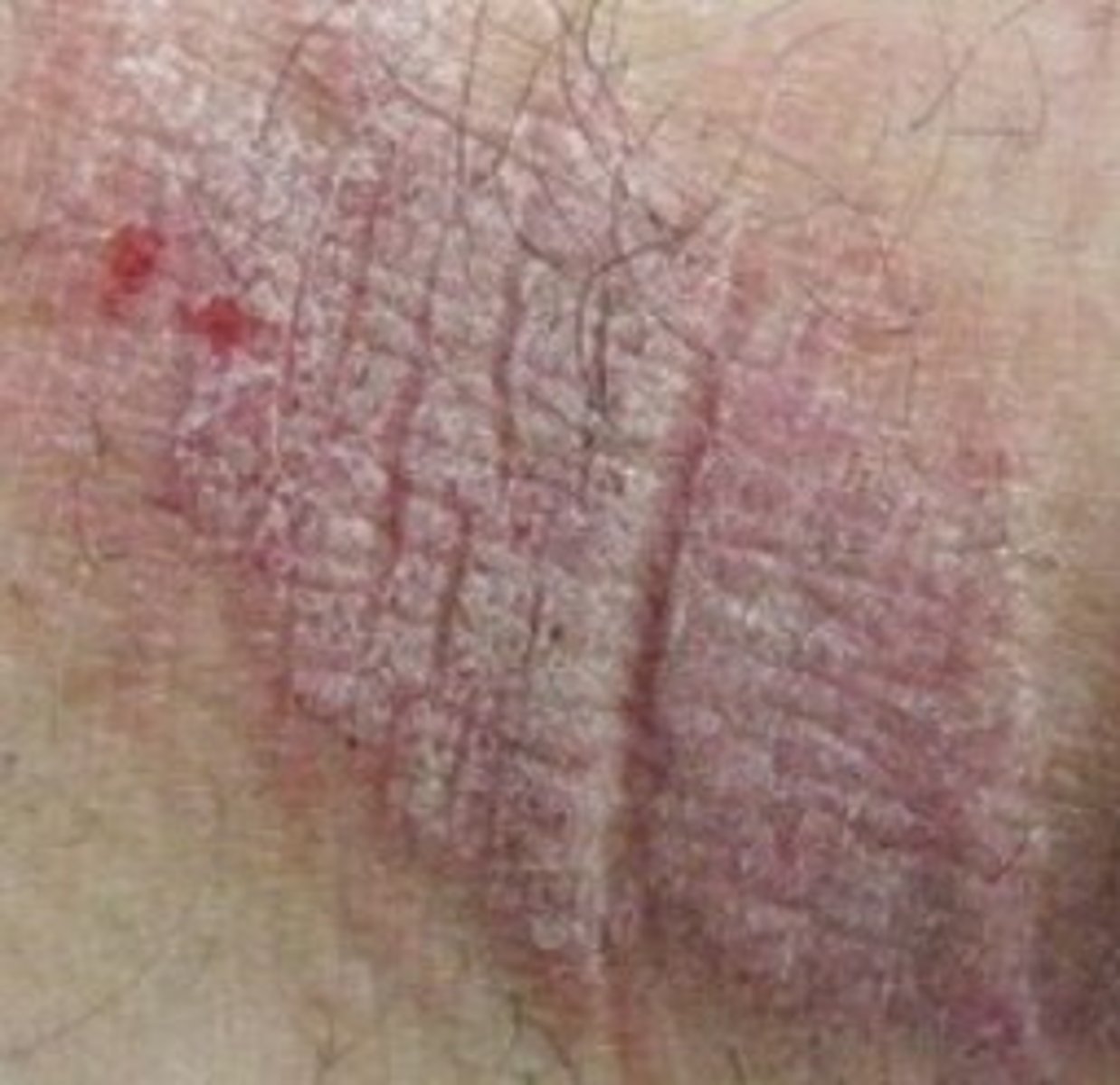 <p>Lichenification (secondary lesion)</p>