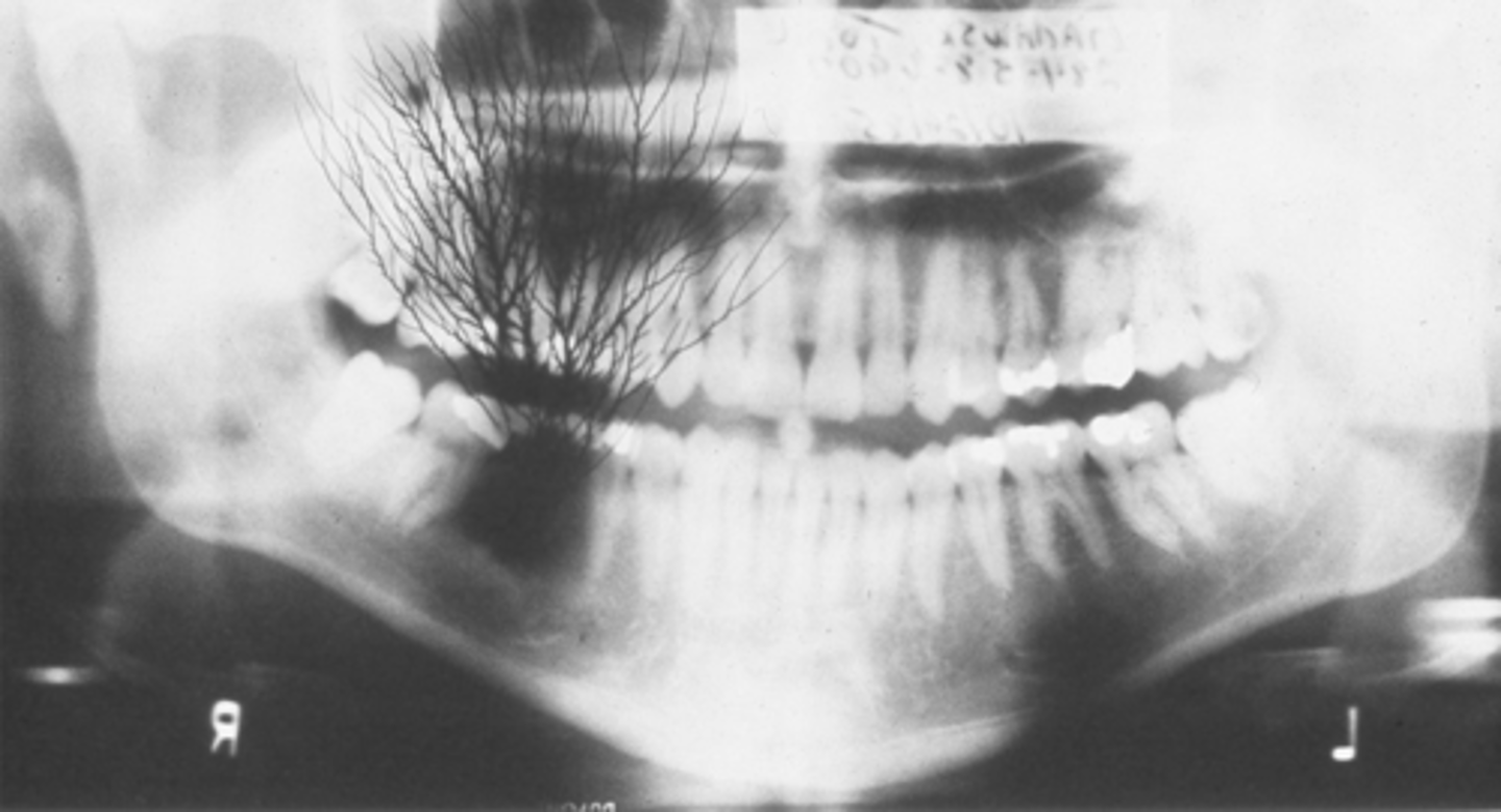 <p>caused by removing film from box or cassette too quickly, creating static discharge</p>