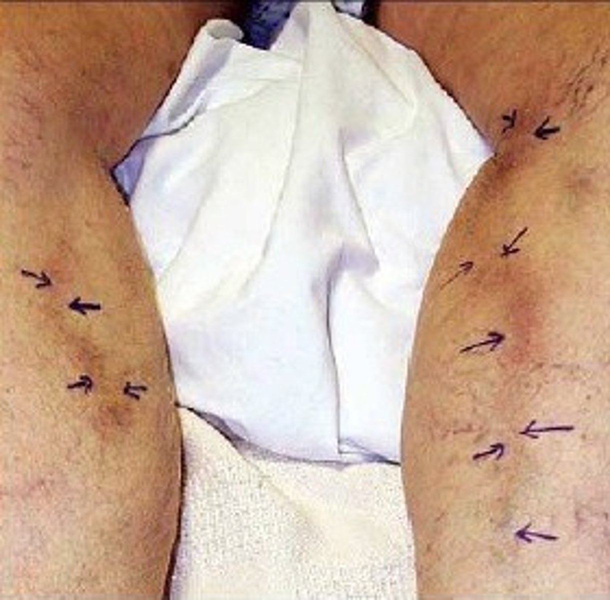 <p>Inflammation and clot formation in superficial veins, usually in the leg</p>