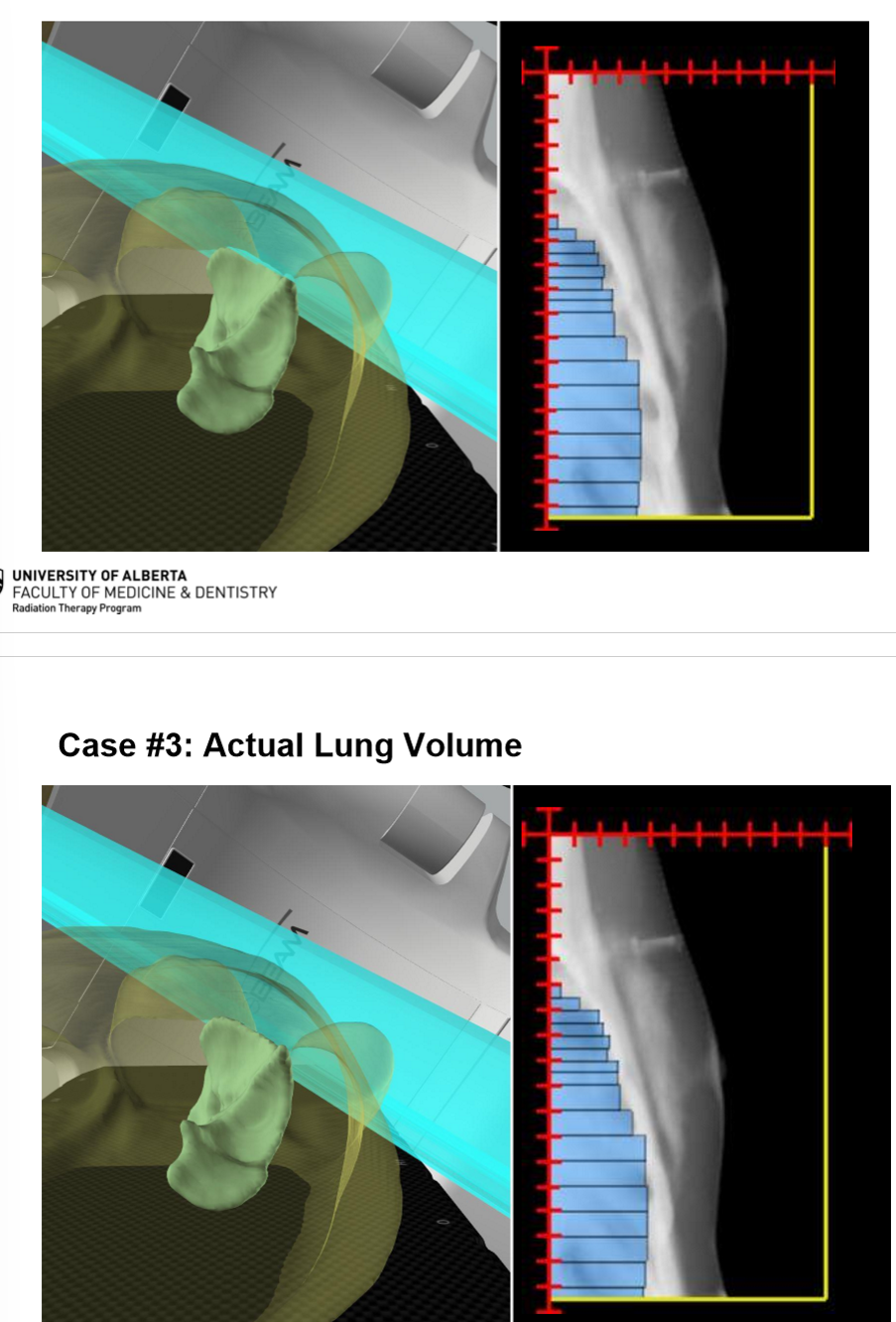 <p>less lung irradiated than what was planned</p>