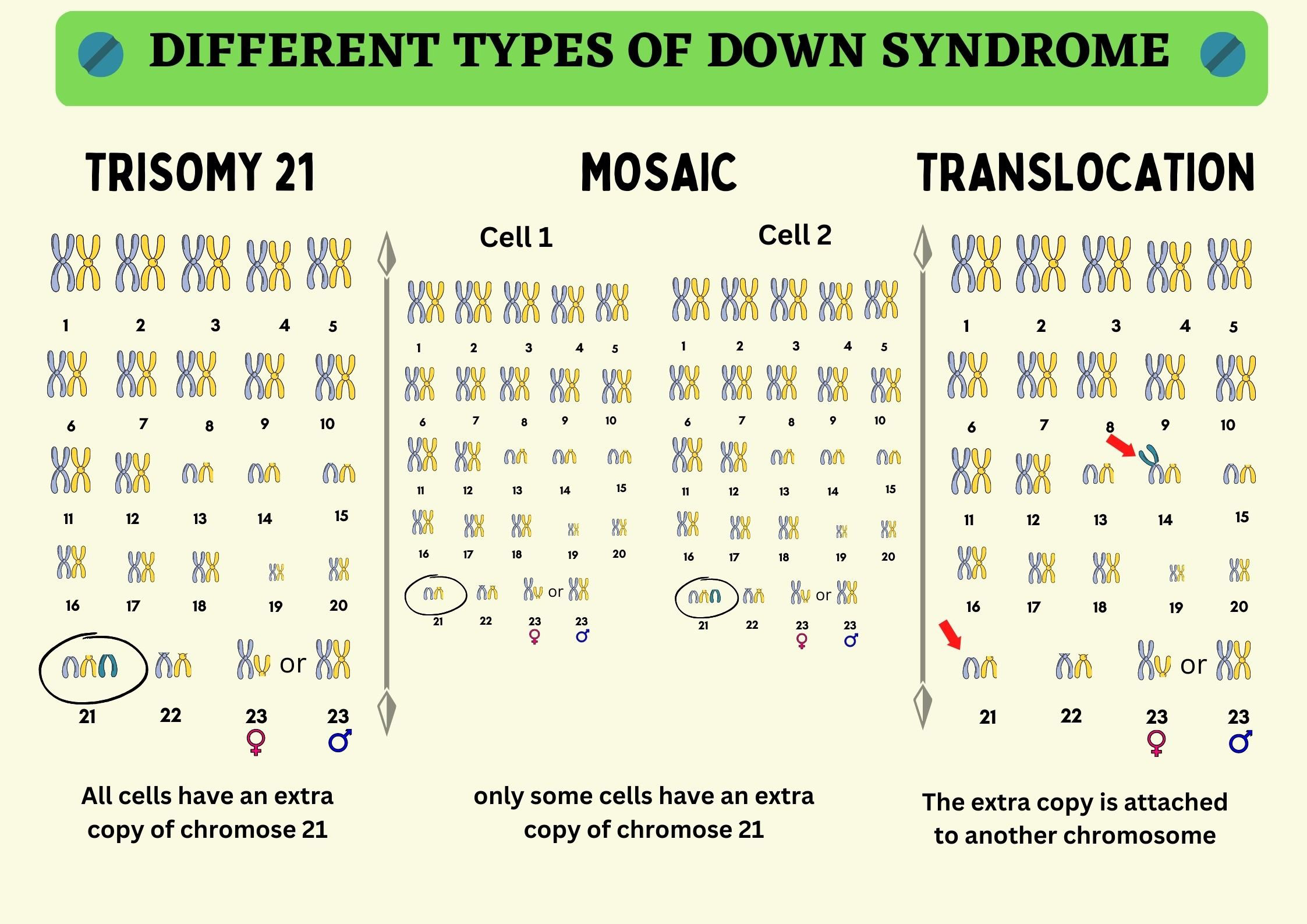 <p>Trisomy 21: Down Syndrome</p><ul><li><p>Primary Down Syndrome: 75% random nondisjunction in egg formation</p></li><li><p>Familial Down Syndrome: Robertsonian translocation between chromosomes 14 and 21</p></li></ul><p></p>