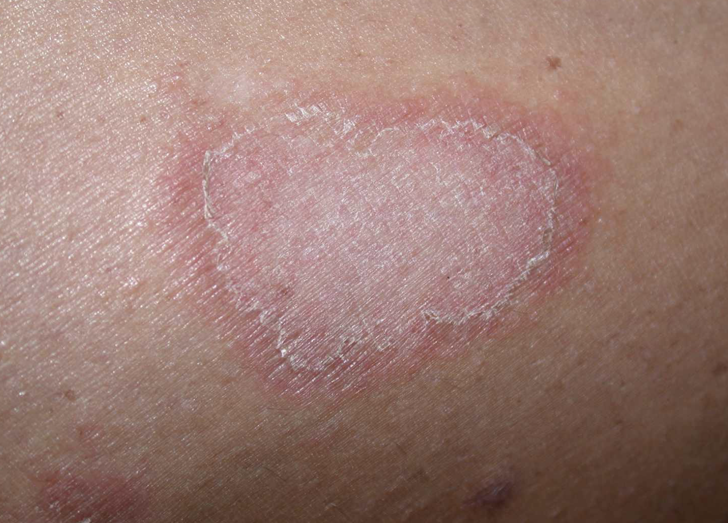 <p>fever, hypertension, inflammation, allergy are the symptoms associated with this particular skin disease</p>