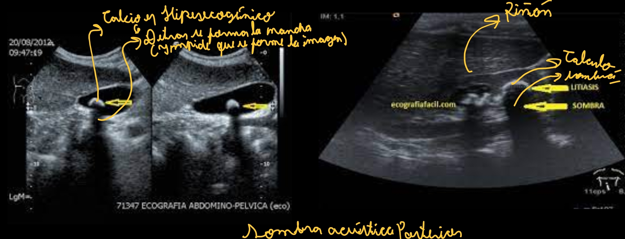 <p>Artefactos:</p><ul><li><p><span style="color: red"><strong>Sombra acústica posterior</strong></span>: Mancha oscura negra, cuando una estructura de calcio. <span style="color: red"><strong>característica de los cálculos (Hiperecogénicos y sombra anecogénica)</strong></span></p></li><li><p><span style="color: red"><strong>Refuerzo acústico posterior</strong></span> (aqui no se ve)</p></li><li><p><span style="color: red"><strong>REVERBERACIÓN </strong></span>(No se ve aqui)</p></li><li><p><span style="color: red"><strong>En espejo</strong></span> (Aqui no se ve)</p></li></ul><p></p>