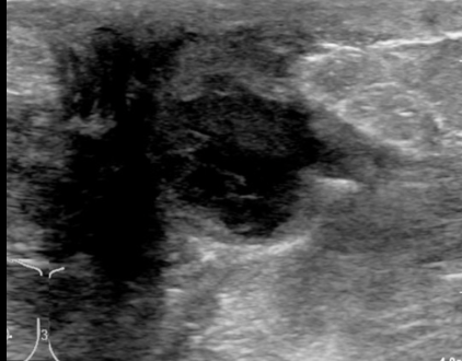 <p>Breast Abscess</p>