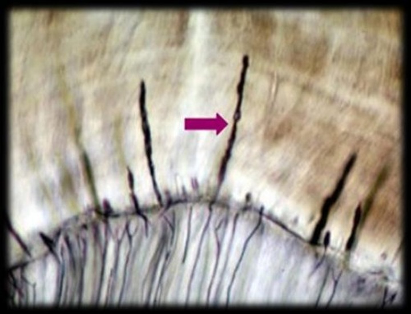 <p>A cellular extension of the odontoblast trapped between ameloblasts, seen histologically and may contribute to slight hypersensitivity.</p>