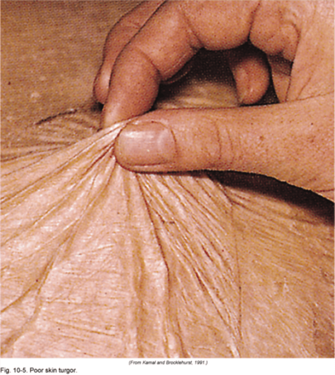 <p>skin tags or acrochordons</p><p>sebaceous hyperplasia</p>