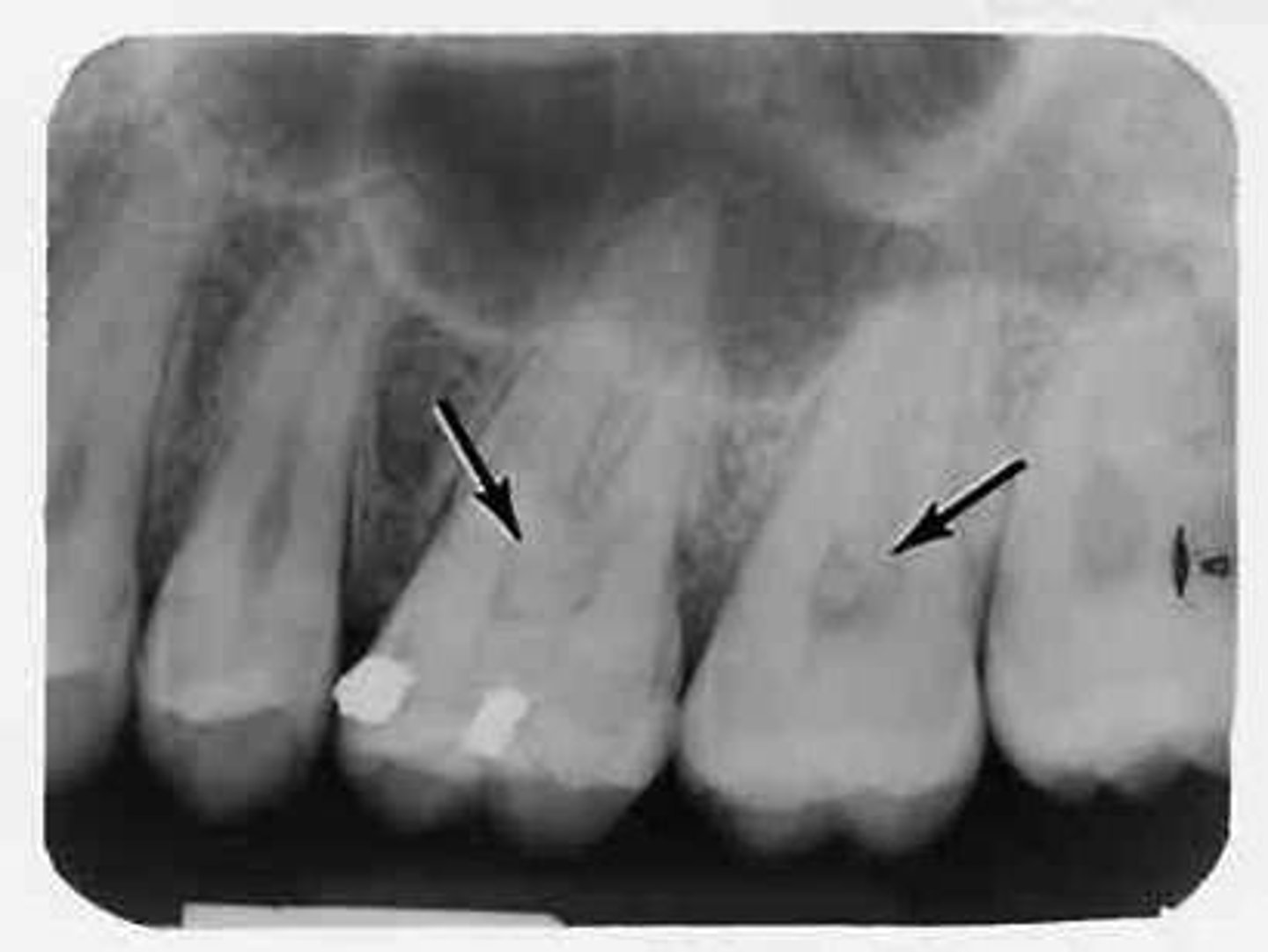 <p>soft, nonmineralized connective tissue</p>