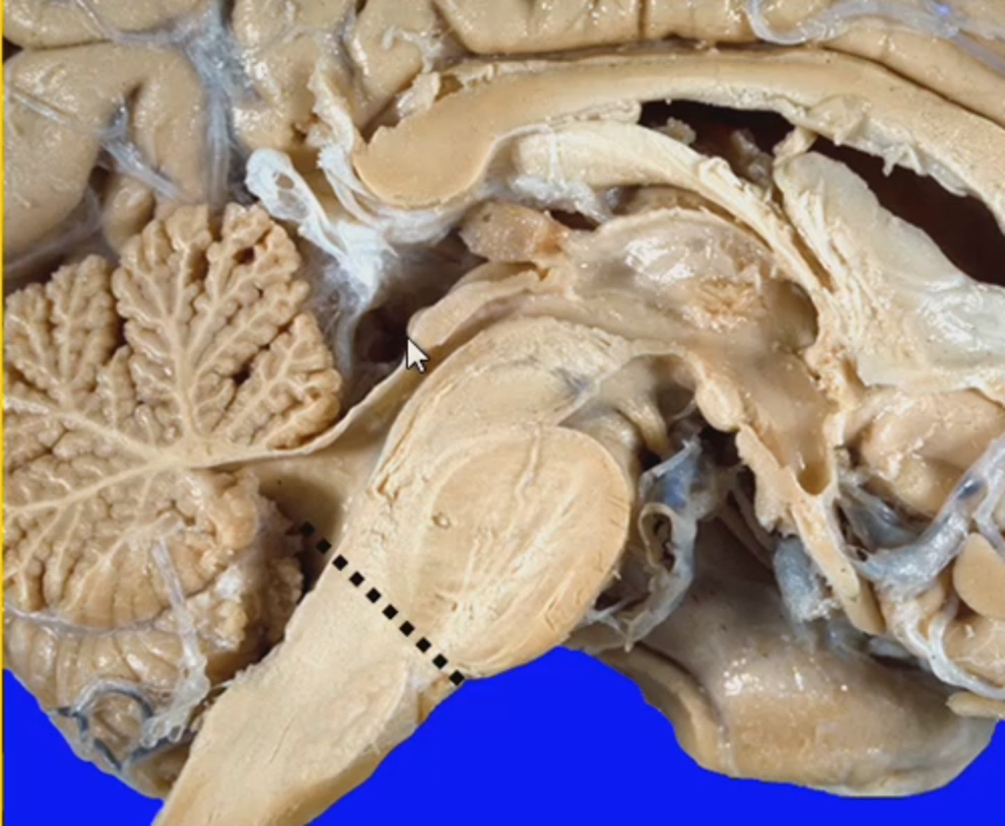 <p>formed by the thoracic outlet (space between the last pair of ribs by the costal arch, the body of the 12th thoracic vertebrae and the xiphoid process or the last sternebra); parietal occipital sulcus</p>
