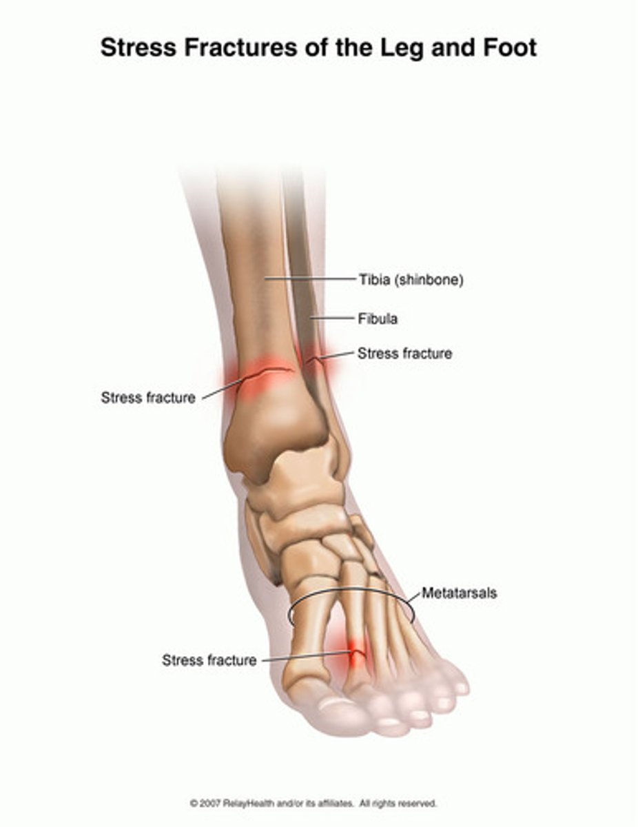 <p>a small crack in the bone that often develops from chronic, excessive impact</p>