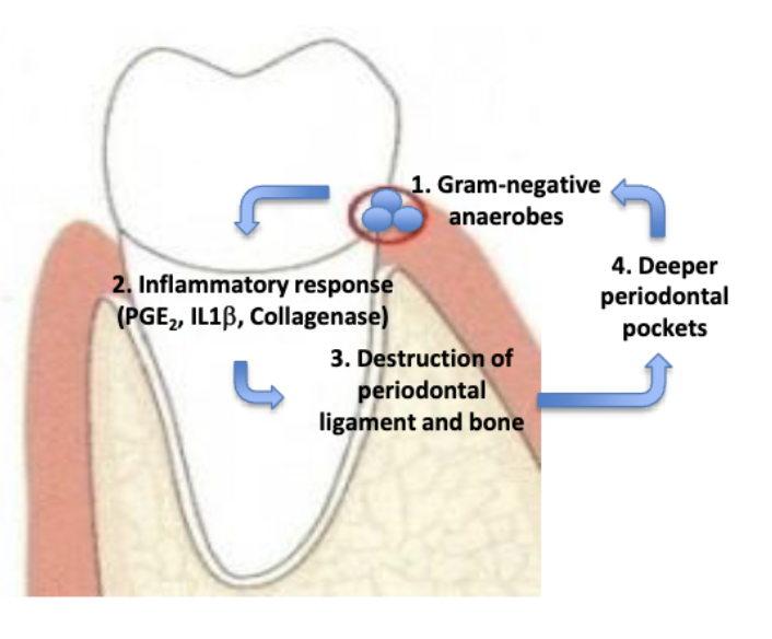 <ul><li><p>Development of deeper pockets create a positive feedback loop</p></li><li><p>Deeper pockets:</p><ul><li><p>contain more bacteria</p></li><li><p>contain more Gram-negative anaerobe bacteria</p></li><li><p>harder to keep clean</p></li></ul></li></ul><p></p>