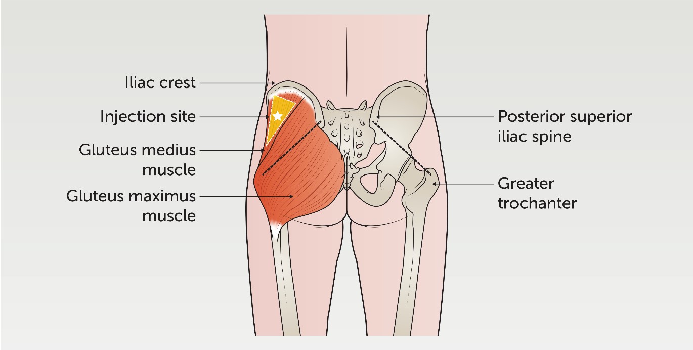 <p>IM Sites: Dorsolateral </p>