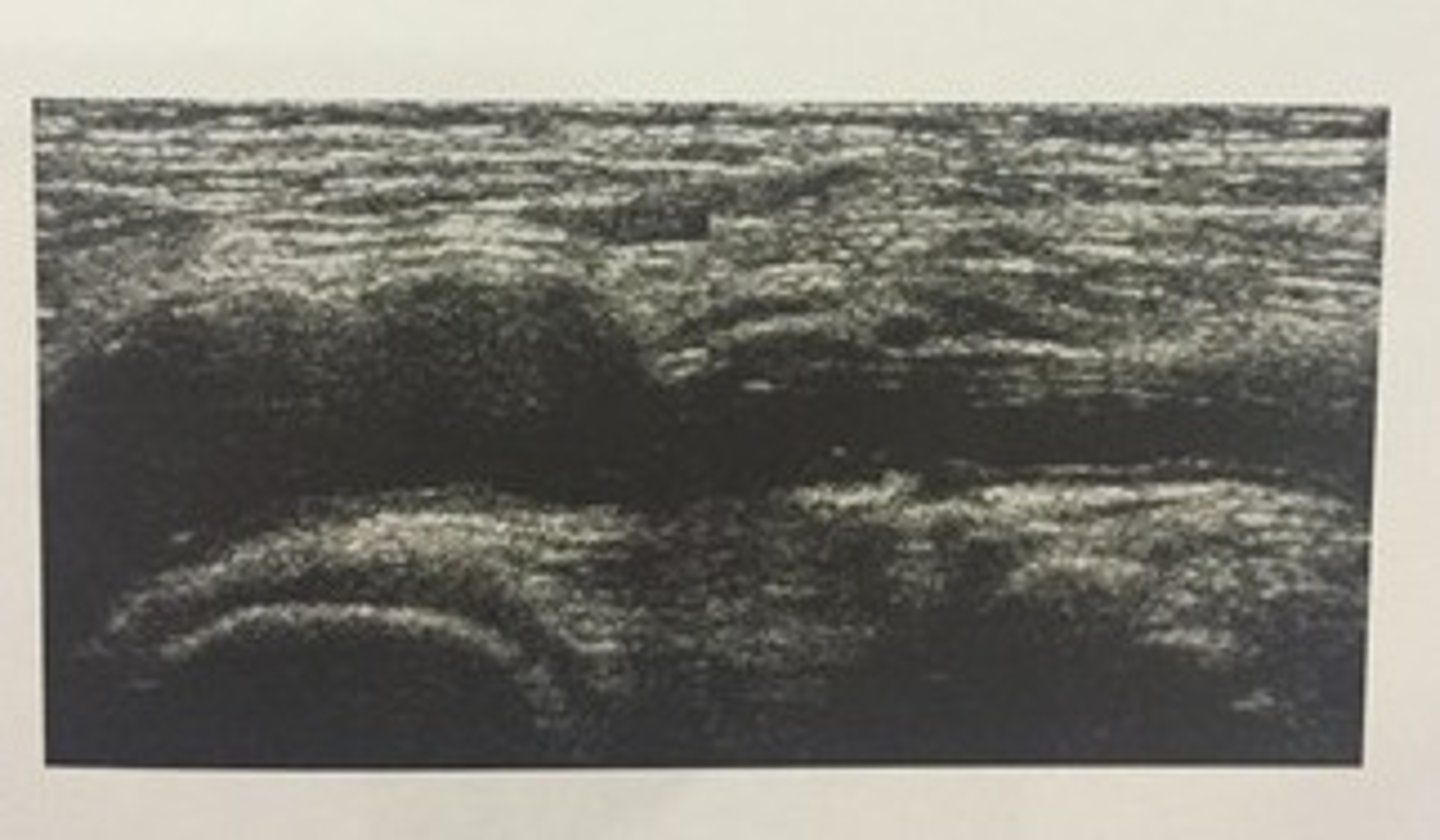 <p>458. (Peripheral arterial measurement techniques)</p><p>This sagittal image was obtained in the popliteal fossa in a patient with blue toe syndrome. What are the ultrasound findings?</p><p>a. popliteal cyst</p><p>b. acute DVT of the popliteal vein</p><p>c. popliteal artery aneurysm</p><p>d. reactive lymph nodes</p>