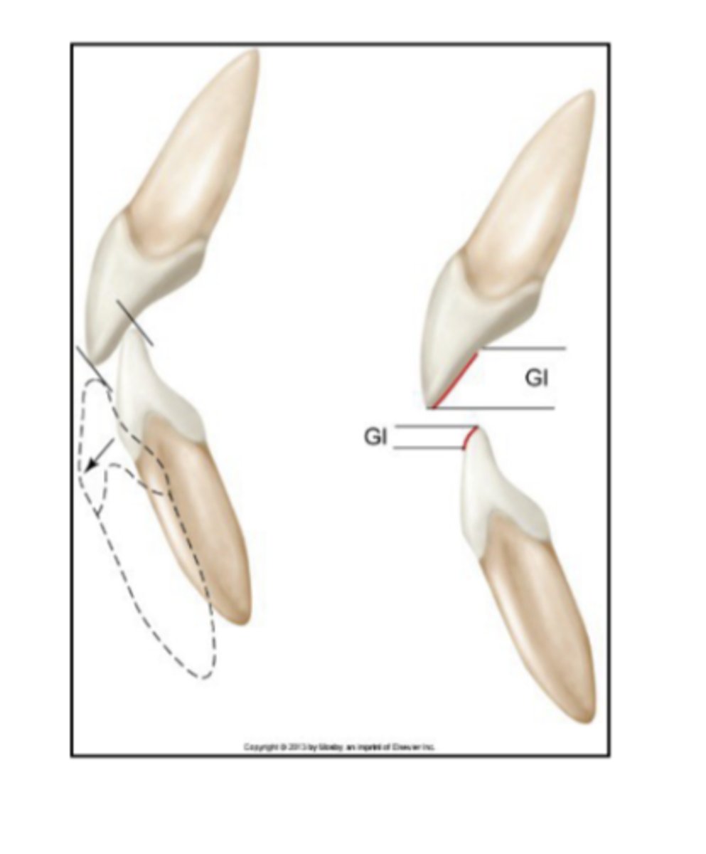 <p>normal occlusal relationship</p><p>between the incisal and labial edges of the mand incisors against the lingual fossa areas and incisal edges of max incisors</p><p>guiding inclines of incisor teeth</p><p>incisal guidance</p>