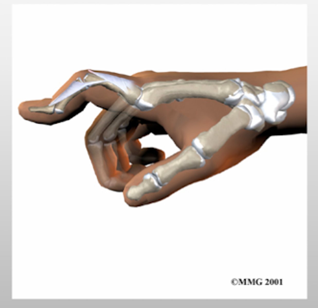 <p>occurs when the central portion of the EXTENSOR tendon ruptures</p><p>PIP joint will be FLEXED due to lack of extensor pull</p><p>DIP joint will HYPEREXTEND </p>
