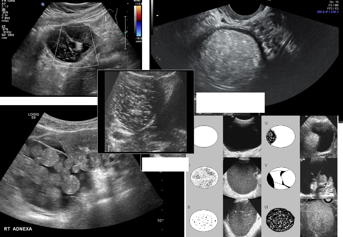 <p><strong>MC benign tumor of the ovary</strong></p><ul><li><p>abdominal pain / enlargement / pressure</p></li><li><p>complex solid mass with fat, teeth, hair, cartilage, bone</p></li><li><p>“tip of iceberg"</p></li></ul><p></p><p><u>Immature type-</u></p><ul><li><p>malignant, rare</p></li><li><p>10 - 20 yrs</p></li><li><p>AFP = HIGH</p></li></ul><p></p><p></p>