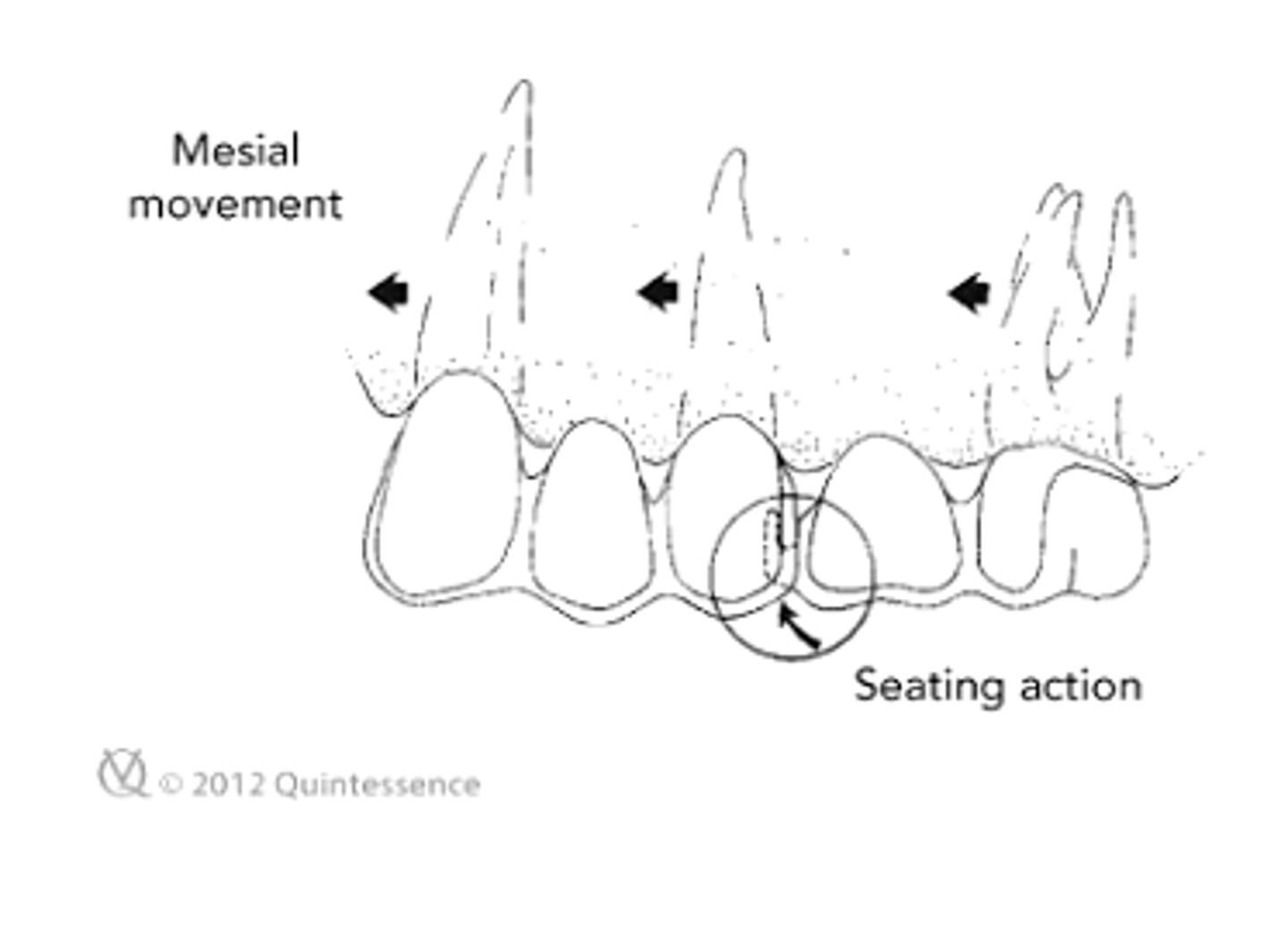 <p>b) distal -- seating action</p>