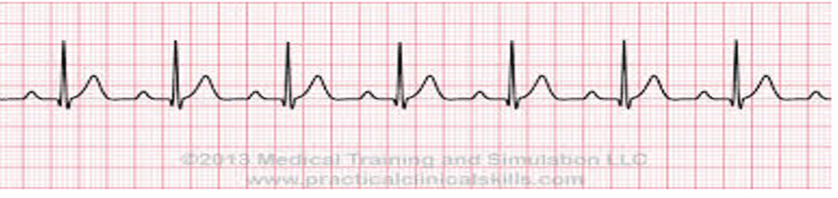 <p>1st DEGREE HEART BLOCK nursing action</p>