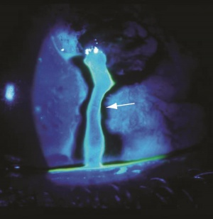 <p>Full eye examination. Fluorescein → Seidel test for presence of aqueous humour leakage from globe</p>