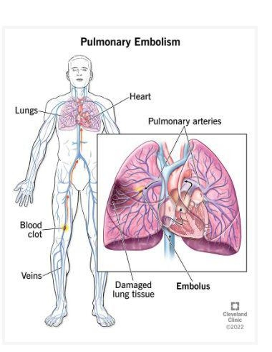<p>Acute shortness of breath, chest pain, tachypnea, and tachycardia.</p>