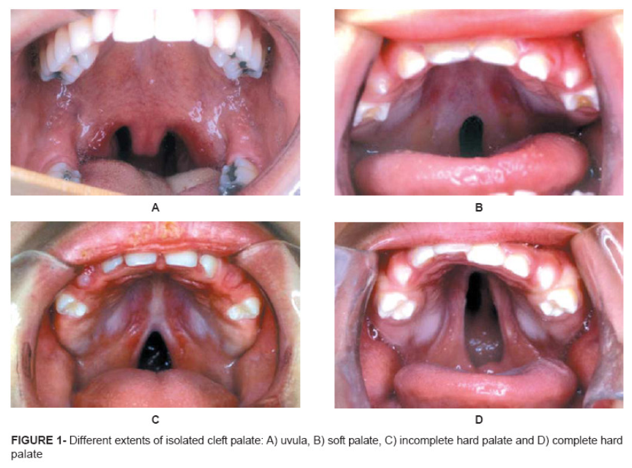 <p>Various degrees of disability due to improper development of the palate. </p>