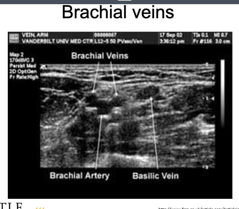 <p>What are key ultrasound characteristics of the brachial veins in upper extremity venous studies?</p>