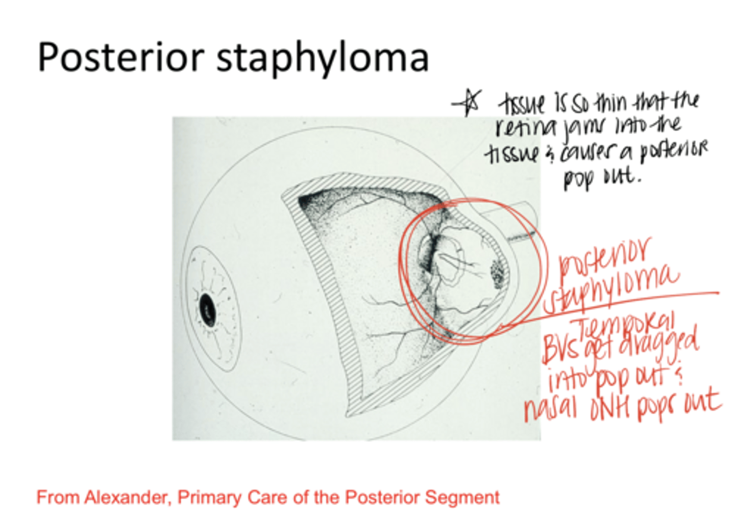 <p>What happens to the temporal optic nerve BVs with a posterior staphyloma?</p>