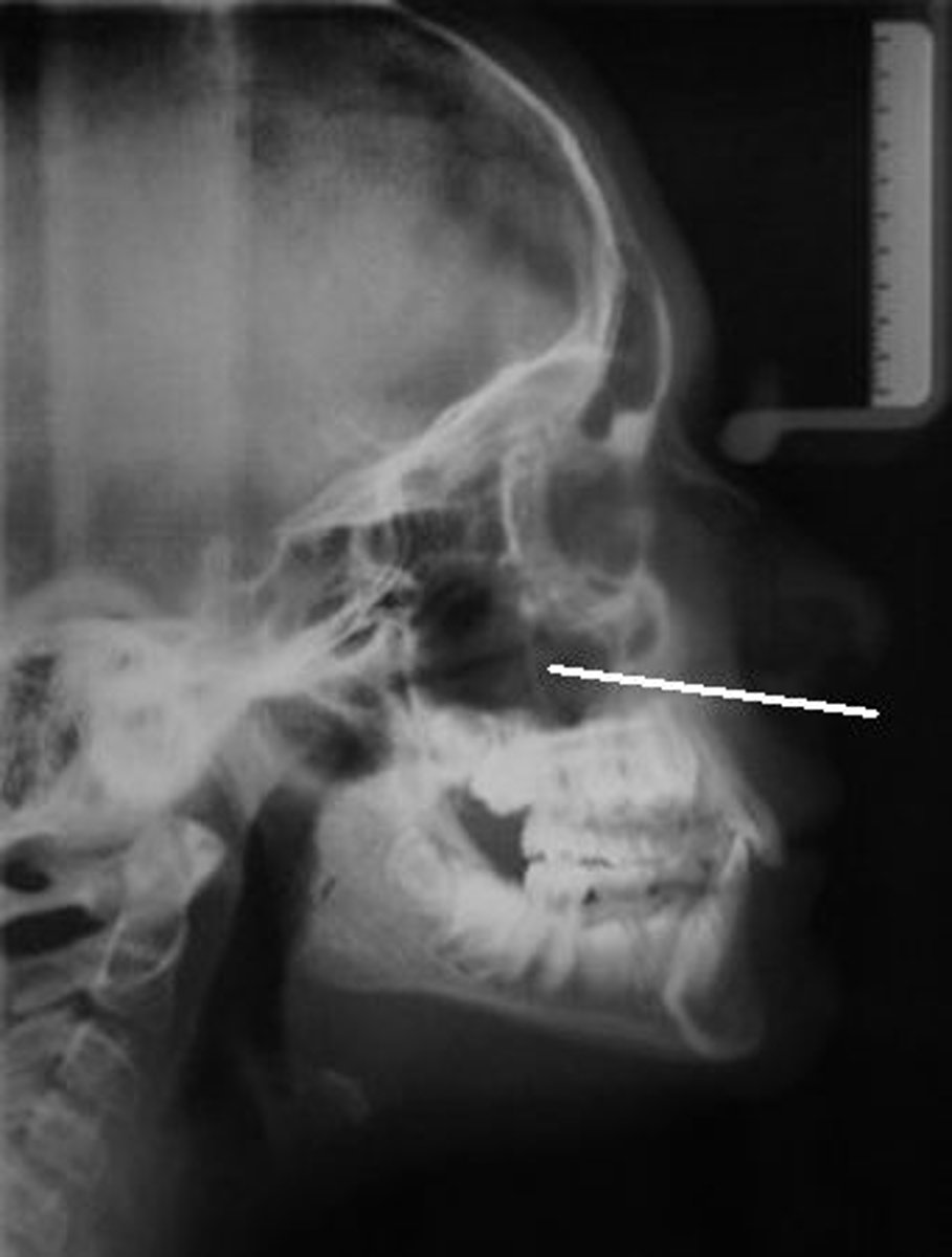 <p>largest sinus and most commonly infected; drains into middle meatus; not seen until 3-5 years old</p>