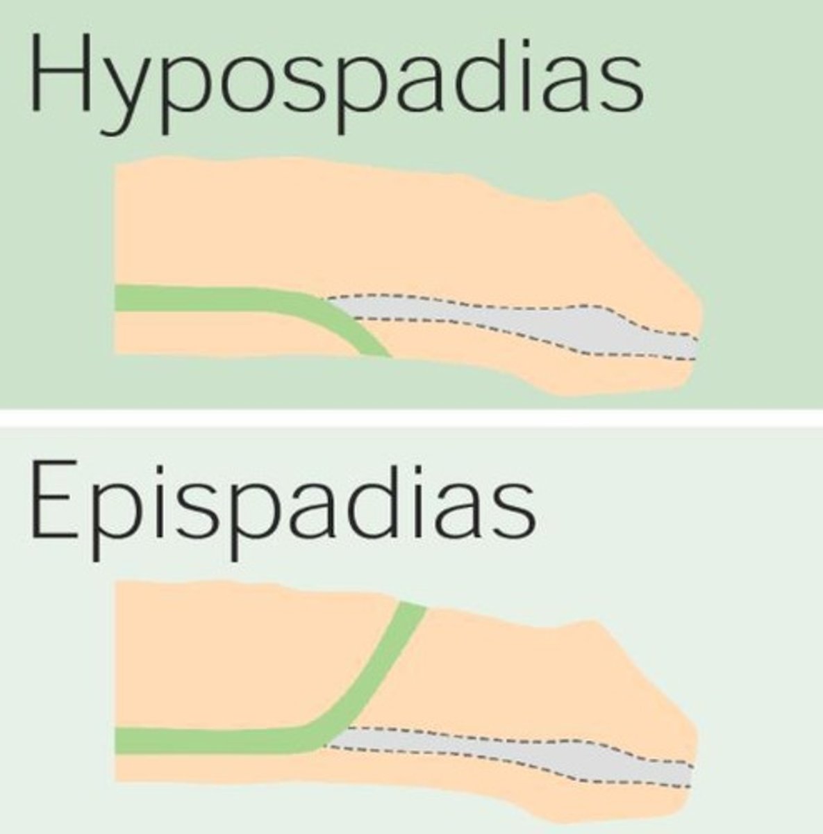 <p>Conditions affecting the urethra's opening in males.</p>