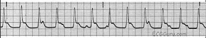 <p>What does this EKG show?</p>