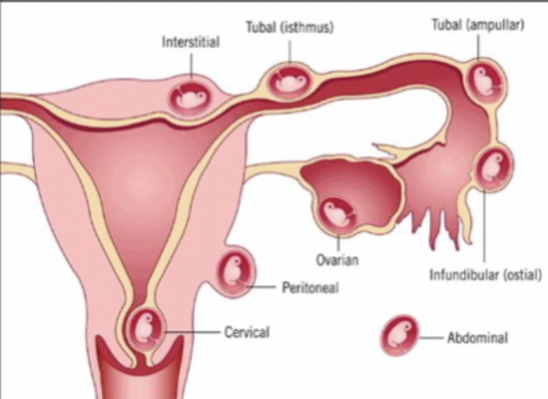 <p>Most common spot for an ectopic pregnancy?</p>