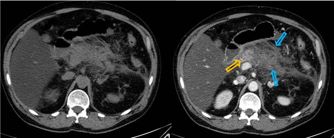 <p>Patient history: fever, intense upper abdominal pain radiating to the back, massively elevated amylase and lipase levels </p><p>Modality: left – Noncontrast CT, right – Contast-enhanced CT, arterial phase, iv. iodine-based contrast agent </p><p>Region: upper abdomen </p><p> Radiologic sign: Enlarged pancreas with indistinct margins (blue arrow); enhancing pancreatic head (yellow arow) reflects living tissue, while hypodens, non-enhancing body and tail suggests necrosis. Increased density of the surrounding mesenterial fat due to fat necrosis; decreased liver density on non-contrast series (see Image 14). </p><p>Diagnosis: acute necrotizing pancreatitis, fatty liver</p>