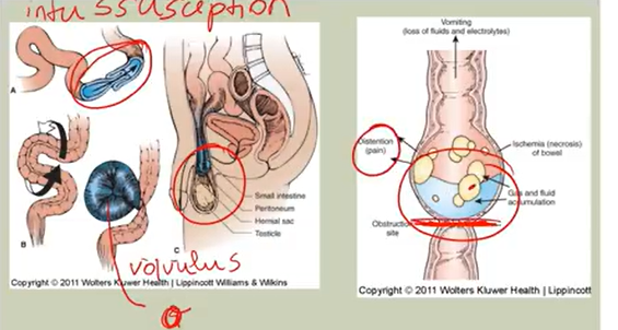 <p>Mechanical: problem of bowel lumen movement patency → distention & electrolyte imbalances → bowel ischemia, acidosis, perforation shock, sepsis</p><ul><li><p>Tumor, scar/adhesion tissue, constipation</p></li><li><p>intussusception, volvulus</p></li><li><p>s/s: </p><ul><li><p>nausea/vomiting, anorexia, diarrhea, fever, colicky pain</p></li><li><p>reduced bowel sounds or borborygmus (hyper active sounds)</p></li><li><p>Peritonitis: fluid escape → peritoneal cavity → board-like rigidity; EMERGENCY</p></li></ul></li></ul><p></p><p>Nonmechanical (Ileus): complete stop of intestinal movement; no blockage (48-72hrs)</p><ul><li><p>Abd surgeries, blood supply disruption there, narcotics/morphine</p></li><li><p>s/s:</p><ul><li><p>Abd cramping/distention</p></li><li><p>Nausea/Vomiting</p></li><li><p>Failure of gas/stool passage</p></li><li><p>No bowel sounds</p></li></ul></li><li><p>t/x:</p><ul><li><p>NPO & NG tube (to decompress)</p></li></ul></li></ul><p></p>