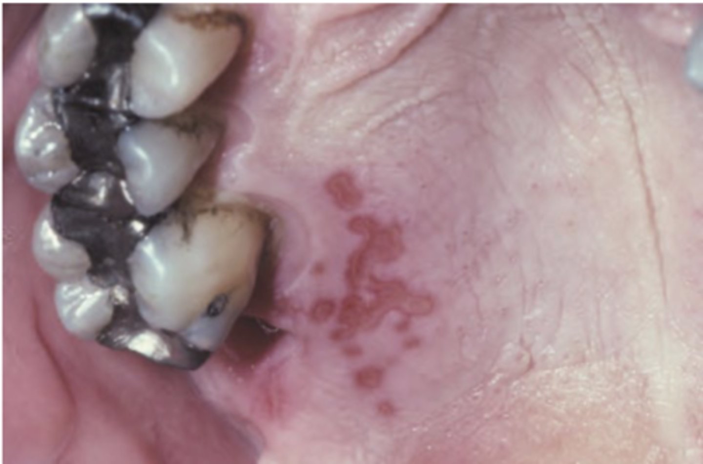<p>Hint: occurs on keratinized mucosa bound to bone (attached gingiva and hard palate)</p>