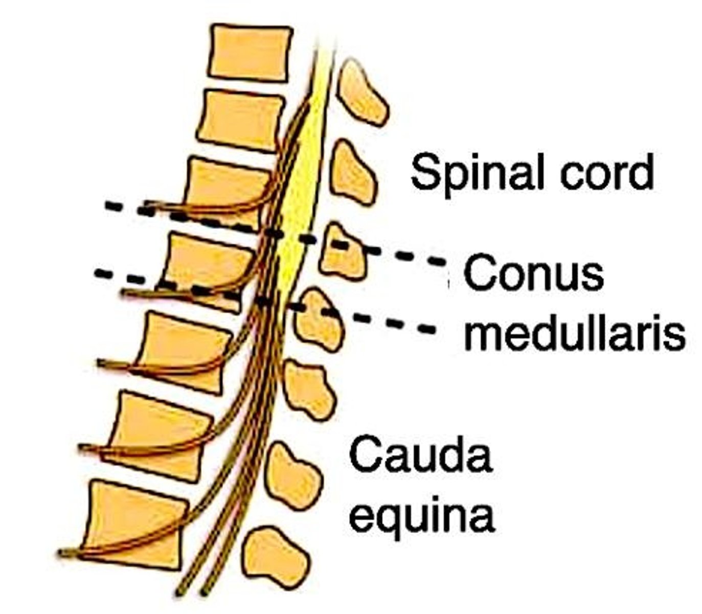 <p>Usually left MCA stroke can lead to Wernicke or Broca aphasia.</p>