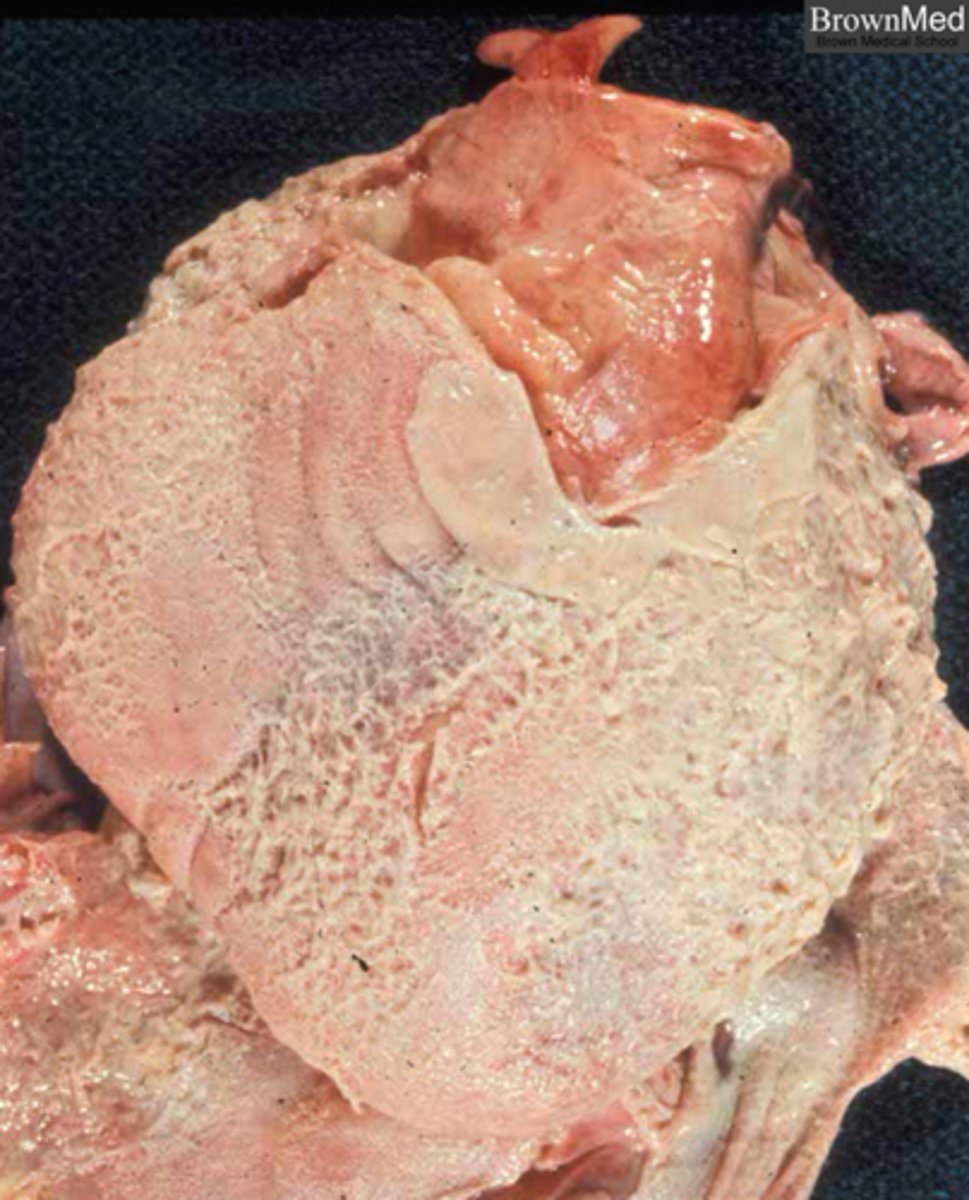 <p>What is the main issue regarding fibrinous pericarditis? What is it most commonly caused by?</p>