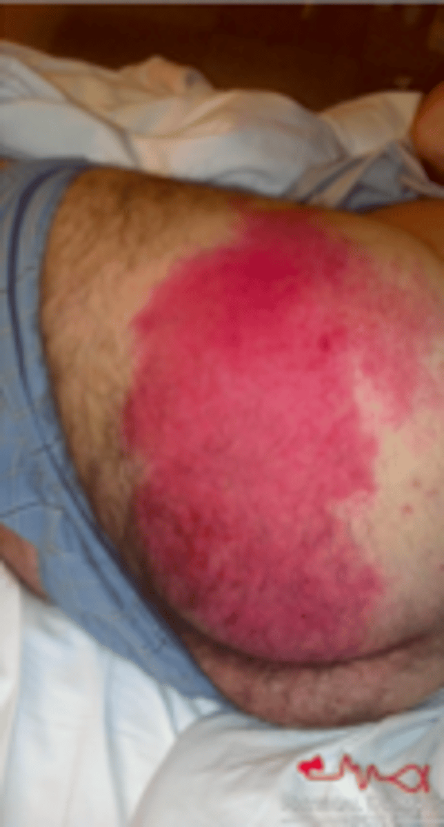 <p>Bacterial ID:</p><p>Objective:</p><p>- Bright erythematous patch of skin with a clearly demarcated raised border</p><p>- Almost always unilateral</p><p>- Can see lymphangitis and regional lymphadenopathy</p><p>- Edema surrounding hair follicles: can lead to skin dimpling</p>