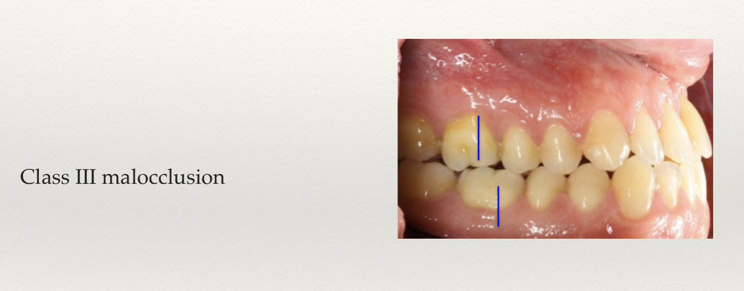 <p>Lower 6 medial to upper molar. <span style="font-size: calc(var(--scale-factor)*36.00px);"><span>line of occlusion not specified; but irregular,depending on different patterns , overcrowded teeth,or space needs.</span></span></p>