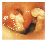 <p>incubation period 2-6 days</p><p>may involve any mucus membrane or skin</p><p>low grade fever</p><p>classified based on site of infection: anterior nasal, tonsillar and pharyngeal, cutaneous, ocular</p><p>treatment with benzylpenicillin or erythromycin plus antitoxin</p><p>infected person may develop bull neck</p>