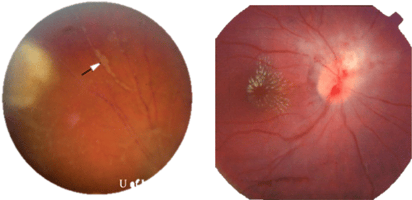 <p>retinal vasculitis</p><p>exudative scar</p><p>focal, hazy vitritis and retinitis</p>