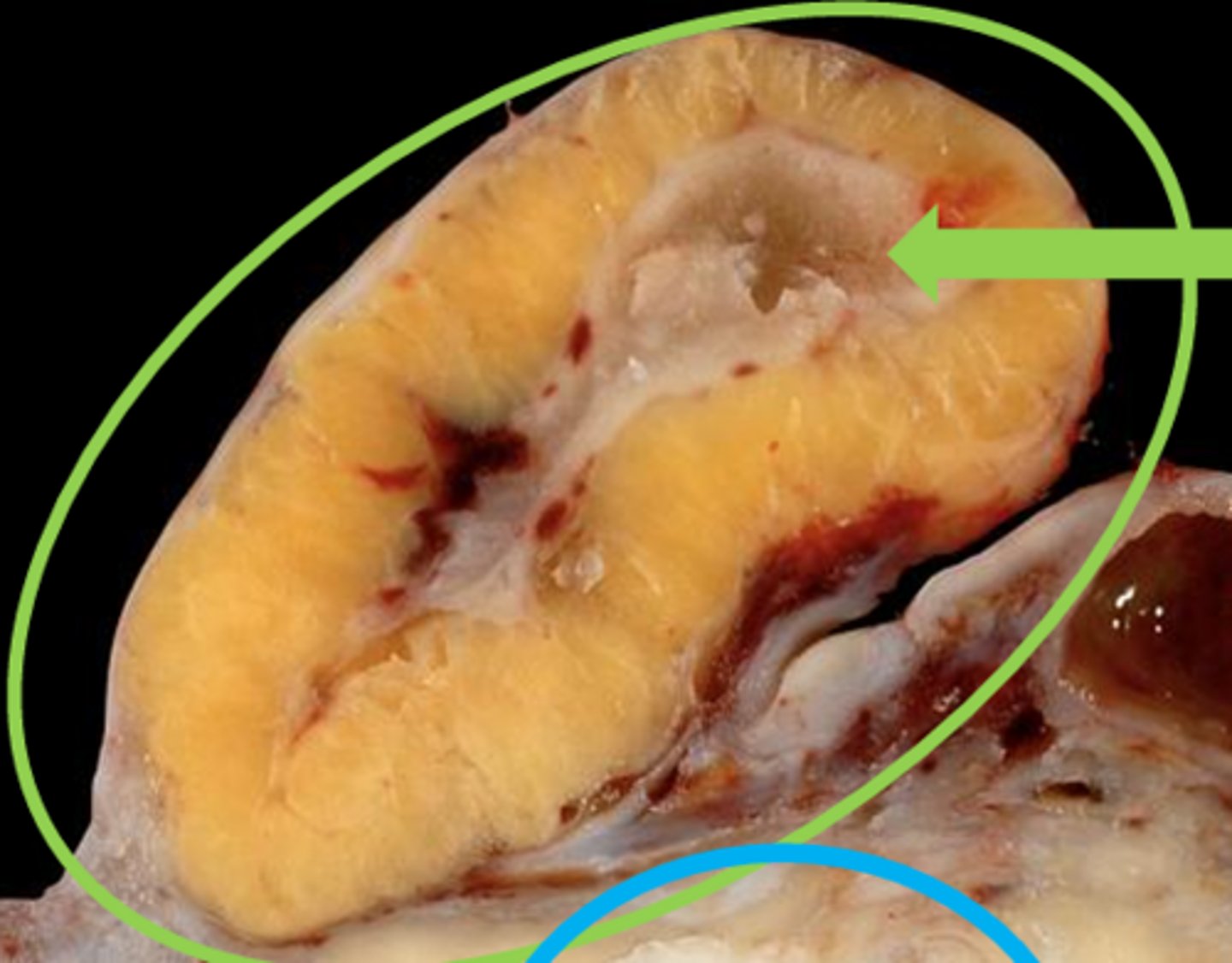 <p>the green arrow is pointing to ______ (central cavity (lacunae) is normal)</p>
