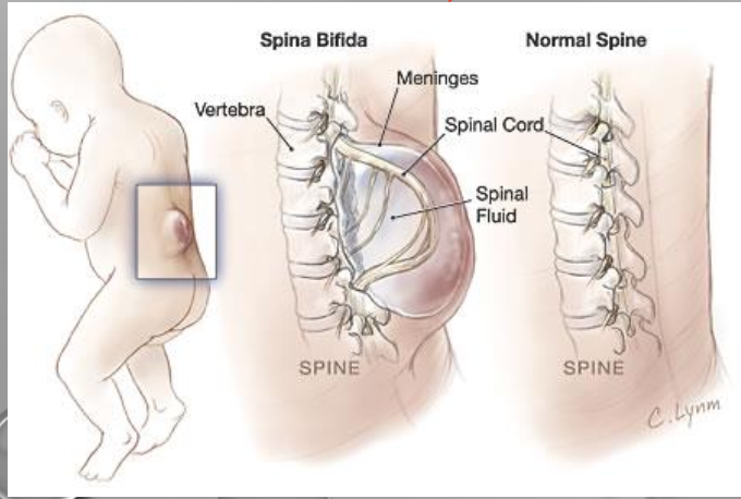 \
* open back
* closing of neural tube failed 