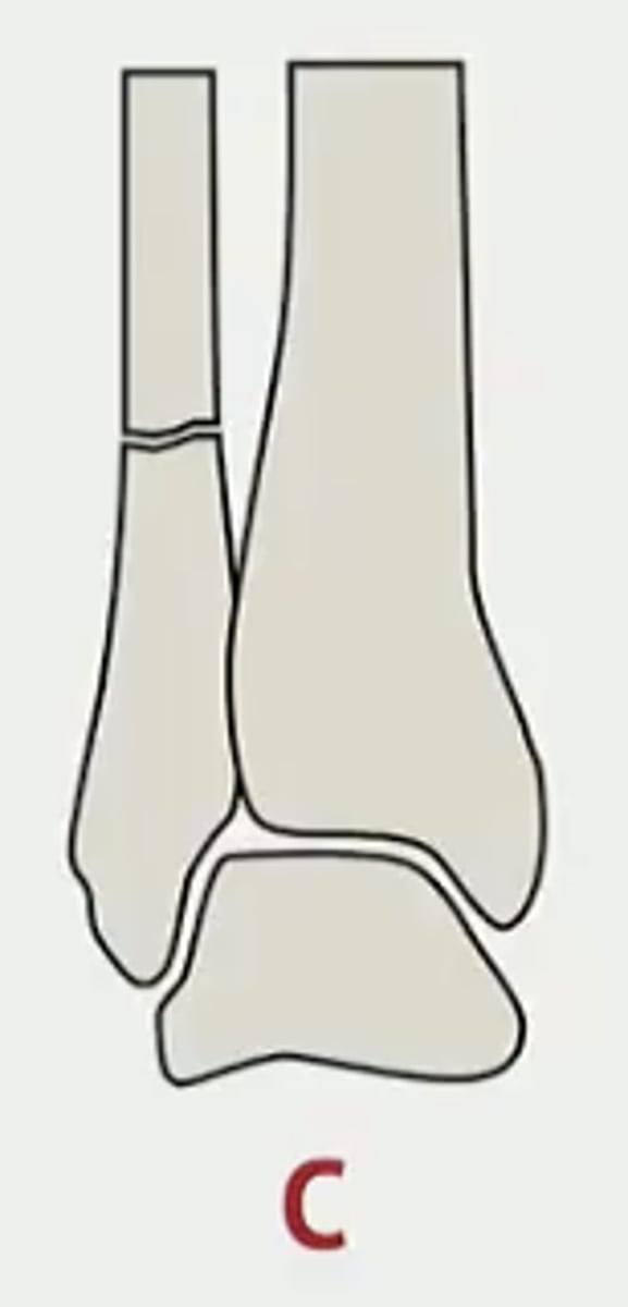 <p>fracture is above the talar dome</p><p>- inherently unstable due to syndesmotic ligament disruption</p><p>- requires surgical fixation, often w/ syndesmotic screw placement</p><p>YES always surgery</p>