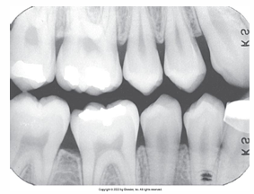 <p>What is the problem with this UNDERDEVELOPED FILM X-ray? </p>