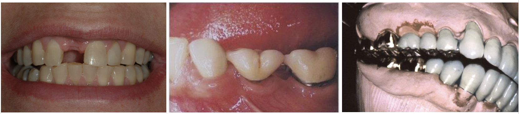<ul><li><p>mesial-distal </p></li><li><p>bucco-lingual width </p></li><li><p>occluso-gingival height </p></li></ul><p></p>