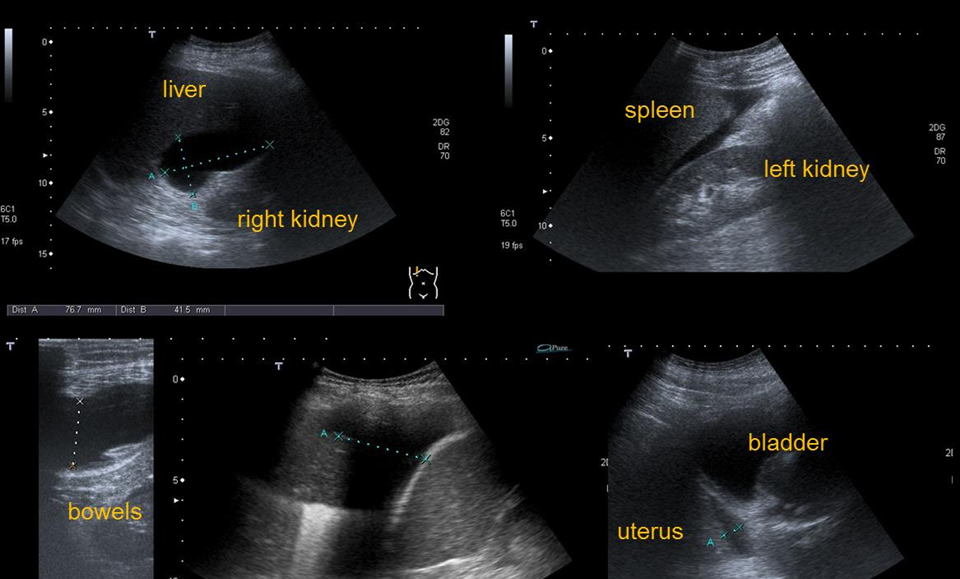<p>Patient history: blunt abdominal trauma </p><p>Modality: FAST (Focused Assessment with Sonography for Trauma) scan </p><p>Region: Abdomen, pleural sinuses, pericardium, aorta </p><p>Radiologic sign: Free abdominal fluid in the hepatorenal fossa, around the spleen, among the bowel loops and in Douglas pouch. </p><p>Diagnosis: Free abdominal fluid after blunt trauma, suspicious for internal hemorrhage.</p>