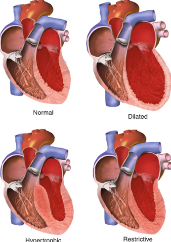 <ul><li><p class="">Myocardium cannot contract properly.</p></li><li><p class="">Most cases are idiopathic.</p></li><li><p class="">May result in heart failure.</p></li><li><p class="">Often requires a heart transplant.</p></li></ul><p><strong>Nursing Management:</strong></p><ul><li><p class="">Monitor for clots.</p></li><li><p class="">Administer vasoactive medications (Beta-blockers, Calcium Channel Blockers, ACE inhibitors).</p></li><li><p class="">Provide diuretics.</p></li><li><p class="">Administer anticoagulants. (rx for bleeding—medical alert bracelet)</p></li><li><p class="">Allow some activity but promote rest.</p></li></ul><p></p>