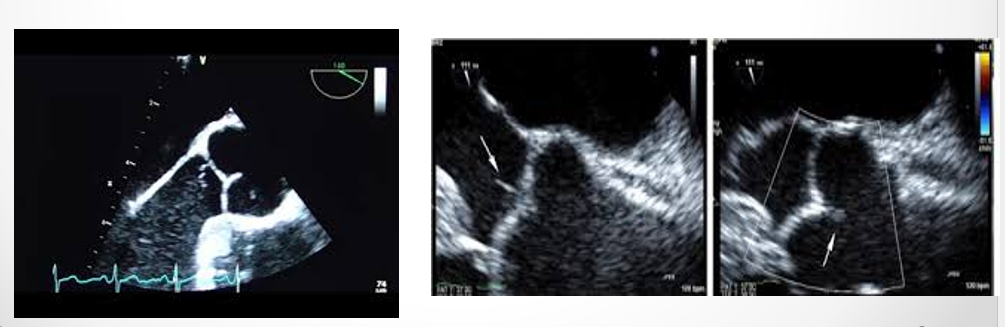 <p>rare thin mobile and filiform cardiac growths that develop at heart valve closure sites </p>