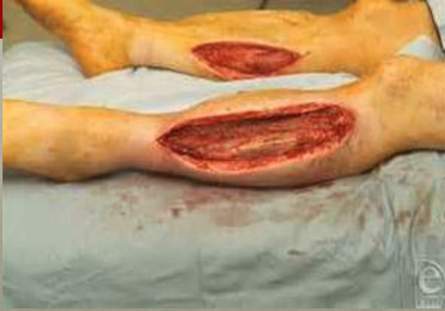 <p>fasciotomy</p>